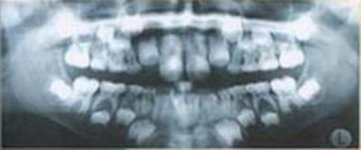 панорамный снимок зубов, видны зачатки постоянных зубов