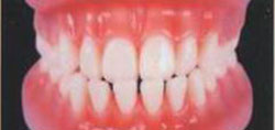 обратное резцовое перекрытие и тремы между зубами