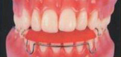 пластинка устраняет тремы между нижними зубами и нормализует положение челюстей при обратном резцовом перекрытии