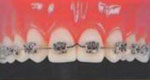 применение брекетов для закрытия промежутков между зубами при адентии