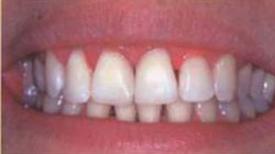 щель между зубами закрыта светоотверждаемым материалом