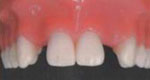 устранена щель между зубами и подготовлено место для протезов