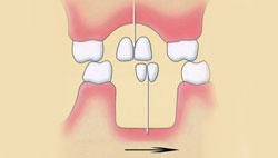 схема положения зубов при одностороннем перекрестном прикусе со смещением