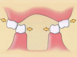 положение зубов при двустороннем лингво-перекрестном прикусе