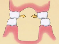 положение зубов при двустороннем перекрестном прикусе