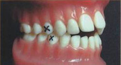 зубы, помеченные крестиком подлежат удалению
