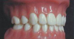 после удаления зубов и ортодонтического лечения