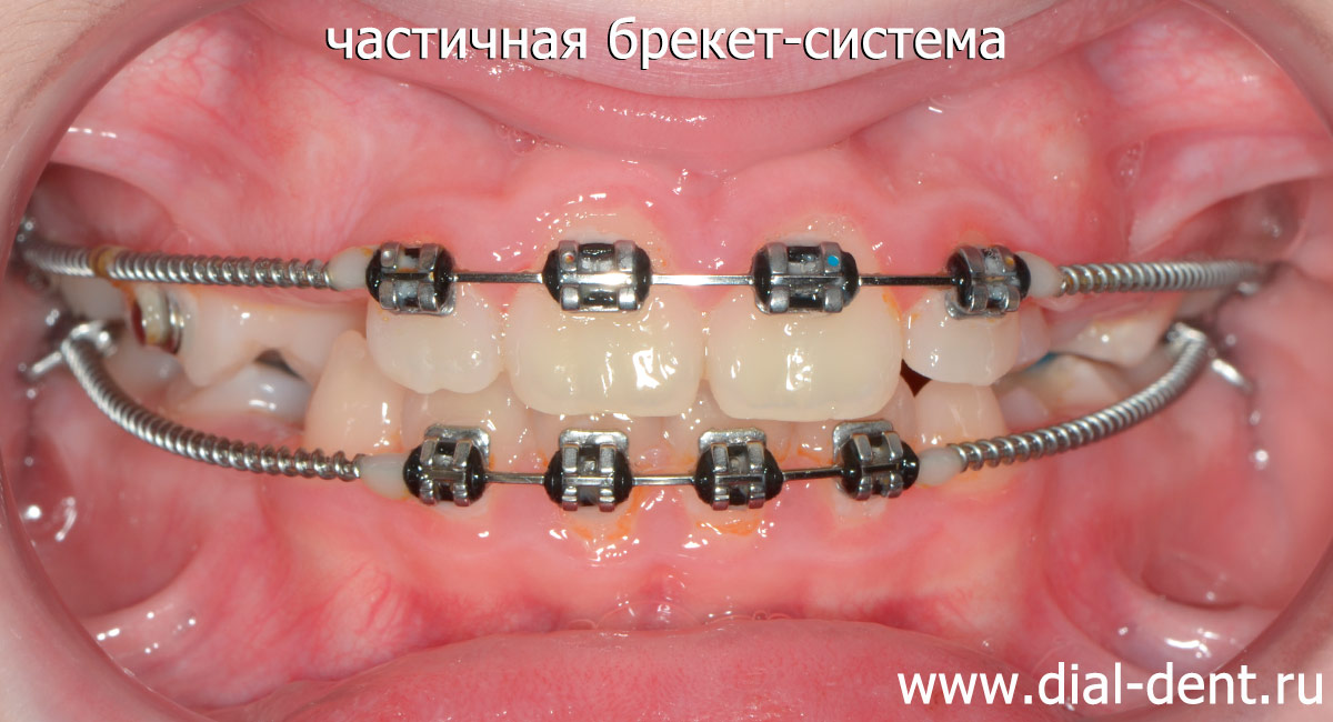 частичная брекет-система применяется при дефиците места в зубном ряду