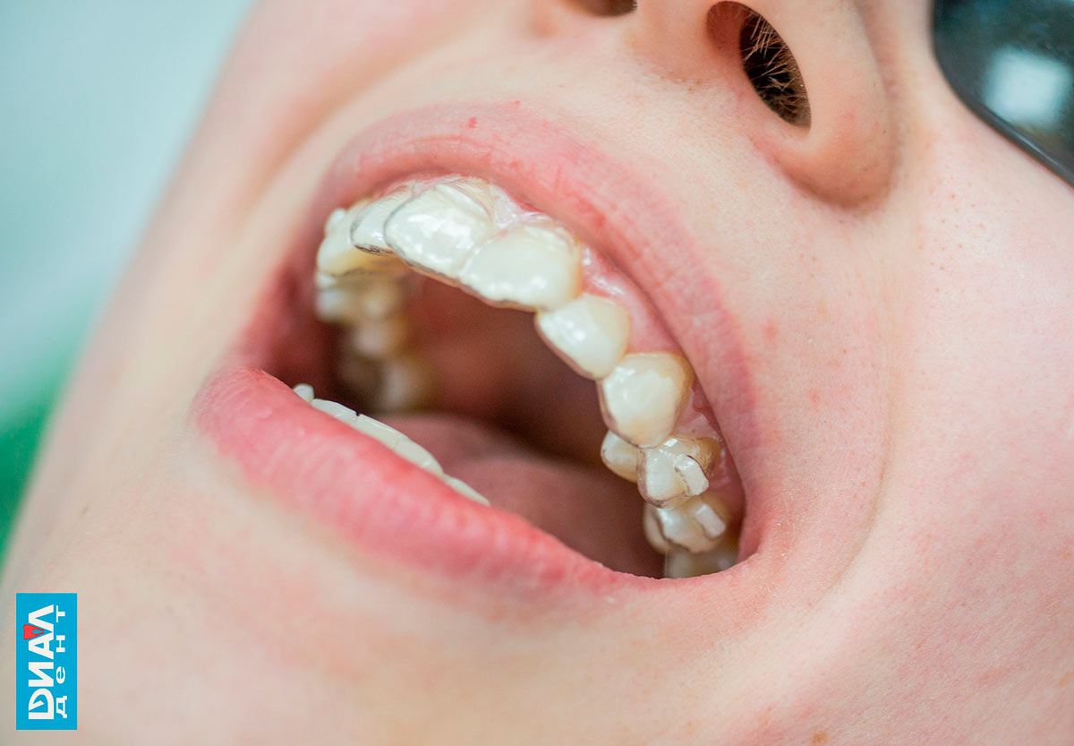 капы 3D Smile на зубах - пример лечения