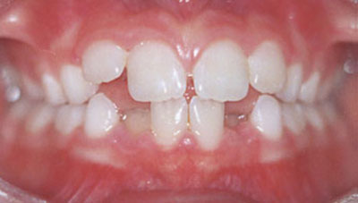 нарушение роста зубов