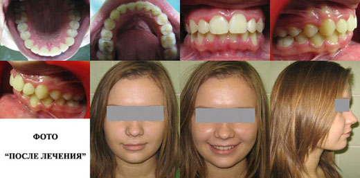 Фото результатов ортодонтического лечения. Ортодонт Баранова О.А.