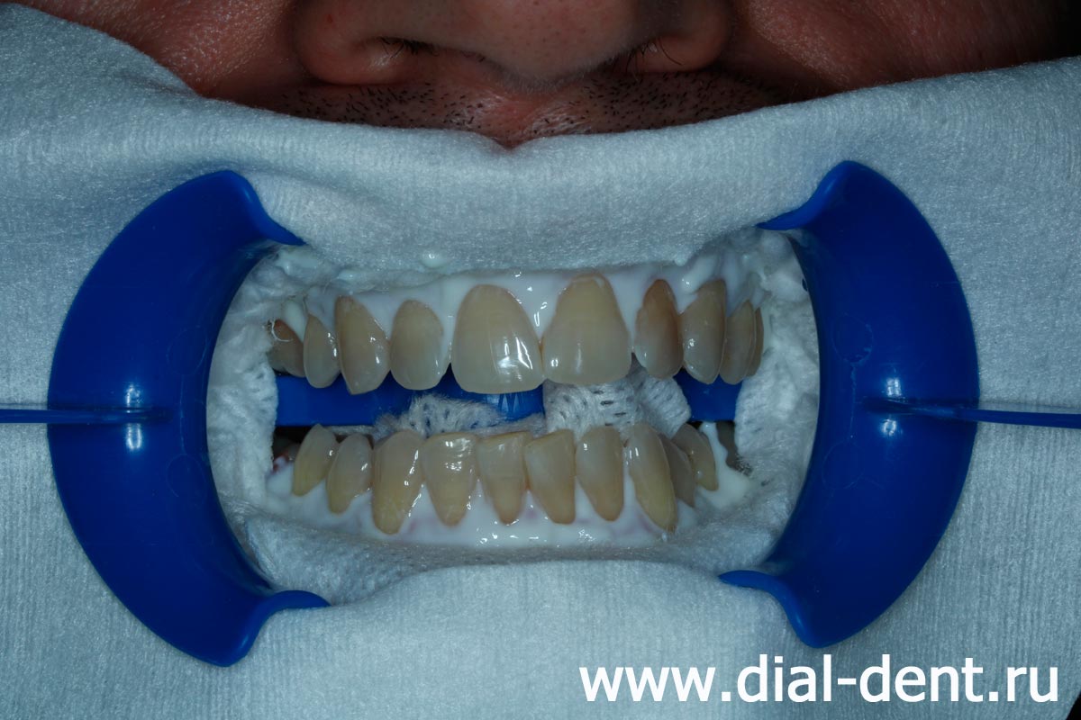 перед отбеливанием зубов необходимо защитить слизистую рта