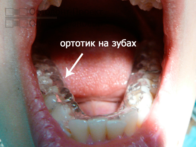 съемный ортотик на зубах