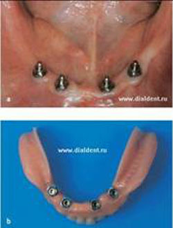 кнопочное крепление зубного протеза
