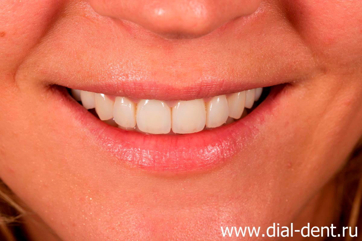 керамические виниры на зубах, работа специалистов клиники Диал-Дент