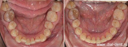 Устранение скученности зубов капами для исправления прикуса 3D Smile