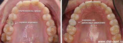 Исправление прикуса элайнерами 3d smile для создания места под имплант и последующая имплантация зуба
