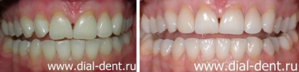 Комбинированная реставрация передних зубов
