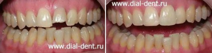 Спортивная травма зубов - откол зуба и сколы соседних зубов