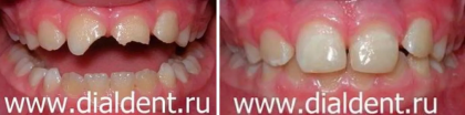 Травма передних зубов у ребенка – лечение под наркозом