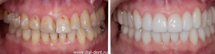 Создание красивой улыбки – от исправления прикуса капами Invisalign до протезирования зубов
