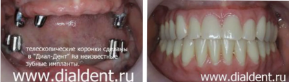 Протезирование зубов на имплантах у пациентки с асимметриeй лица и невропатией лицевого нерва