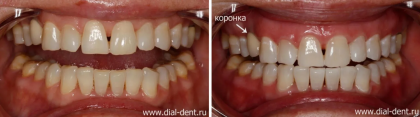 ZOOM 4 (Philips Zoom) отбеливание зубов