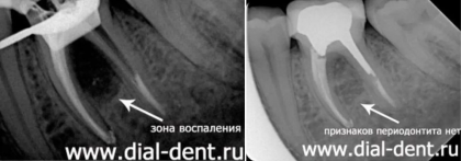 Хронический периодонтит – диагностика и лечение