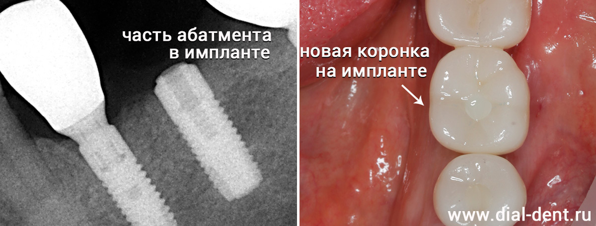 Сохранение импланта при поломке абатмента: пошаговое лечение и профилактика