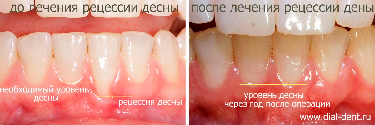 Закрытие рецессии десны после исправления прикуса