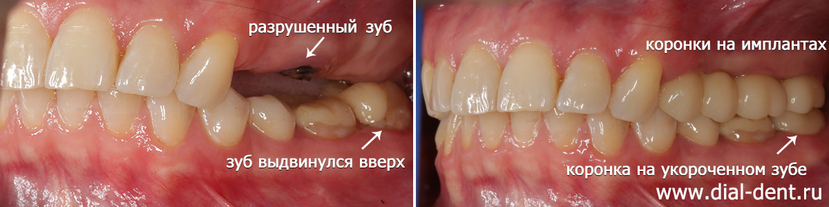 Удаление зуба, установка трех имплантов и керамических коронок на импланты