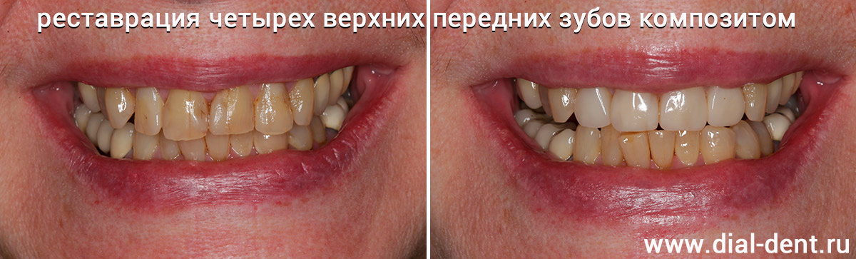 Новая улыбка в 65 лет: художественная реставрация передних зубов
