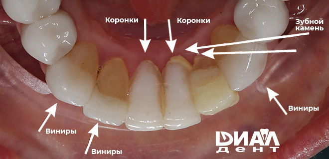 Два их шести виниров оказались не винирами а коронками. Материал полностью покрывает зуб со всех сторон. 