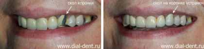 Ремонт скола металлокерамической зубной коронки