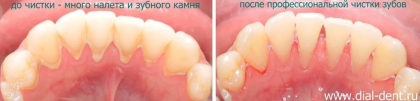 Профессиональная гигиена в помощь электрической зубной щетке