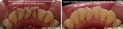 Тестирование электрической зубной щетки Philips sonicare