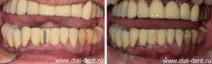 Ремонт скола металлокерамической коронки без снятия коронки