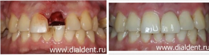 Удаление сломанного зуба и одномоментная имплантация