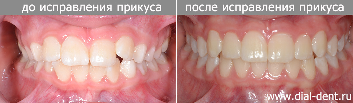 Ортодонтическое лечение ребенка с применением детских кап для исправления прикуса