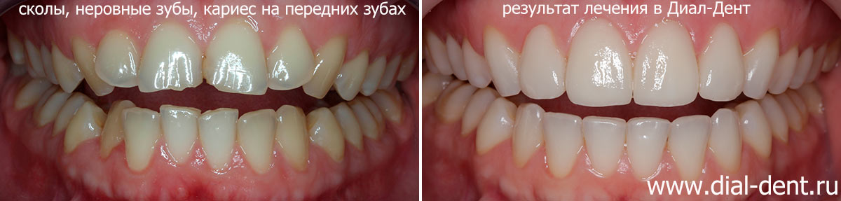 Виниры на передние зубы с ортодонтической подготовкой и лечением бруксизма (брекеты WIN)