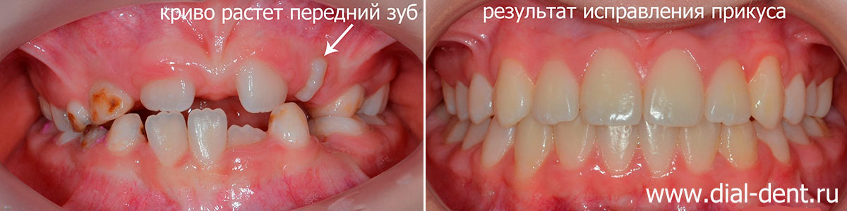 Раннее ортодонтическое лечение ребенка с расширением верхней челюсти