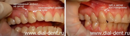 Рецессия десны и клиновидный дефект зуба