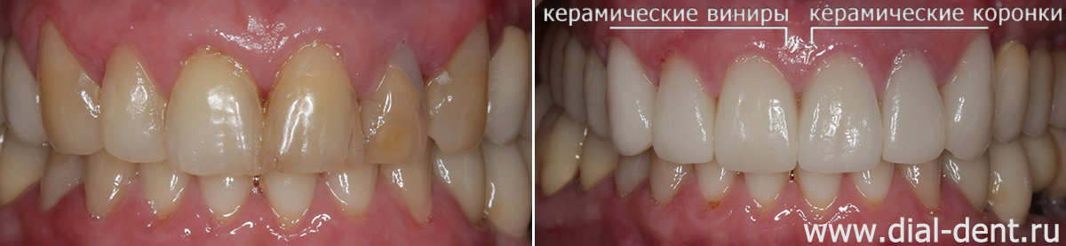 Реставрация 6-ти передних верхних зубов винирами и коронками