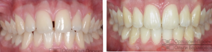 Щель между передними зубами закрыта капами Invisalign