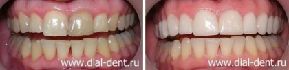 Виниры без обточки для улучшения вида зубов