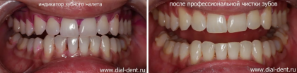 Чистка налета курильщика в период ортодонтического лечения