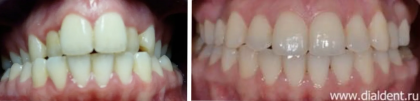 Ортодонтическое лечение перед имплантацией зубов