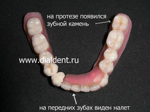 Чистка съемных зубных протезов в приборе MicroClean