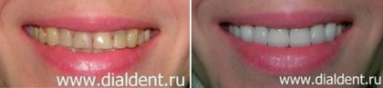 Керамические виниры для эстетики передних зубов