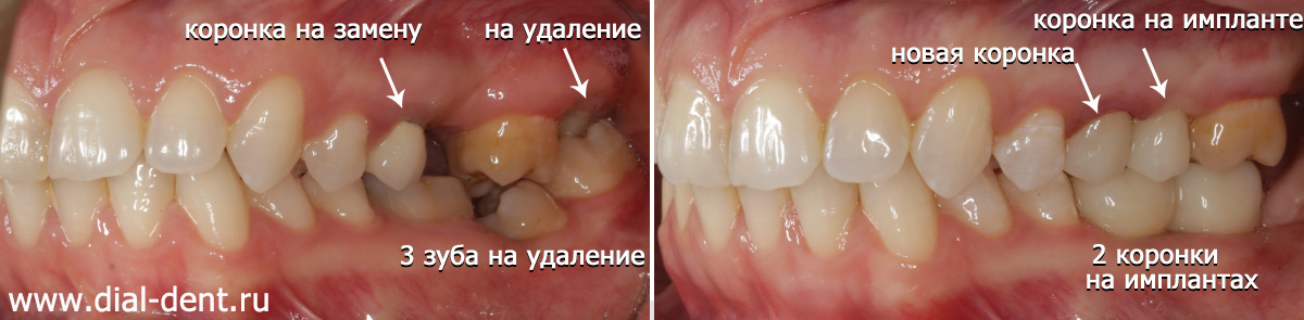Восстановление жевательных зубов имплантами